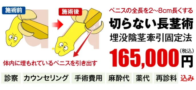 包茎も改善！切らない長茎術