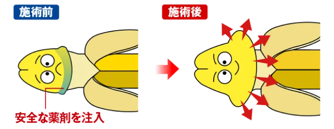 カリ高注入法